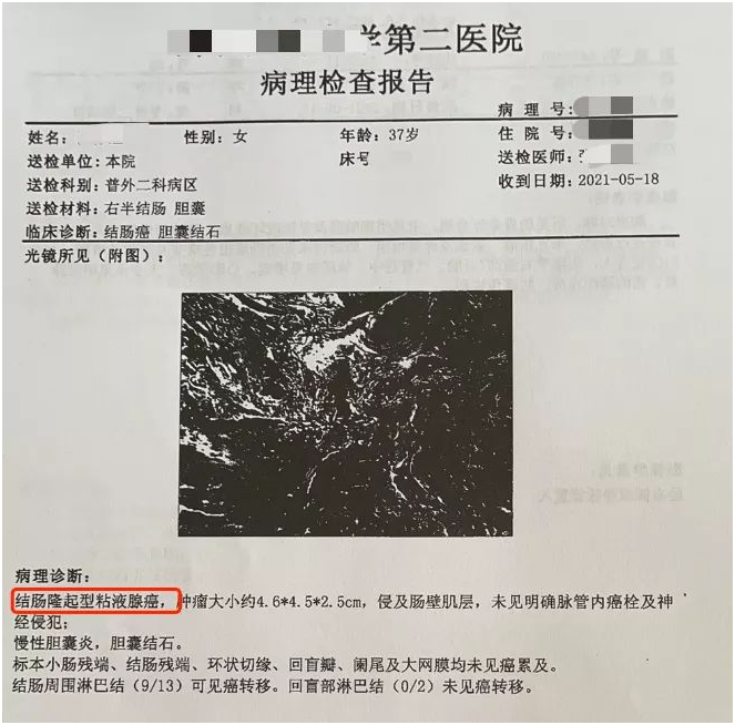 37歲女性患結(jié)腸癌,尊享e生賠付5萬多