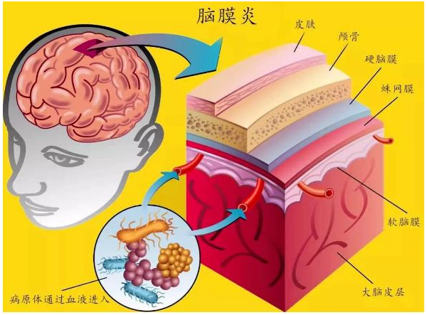 吃出來的腦膜炎,竟是